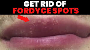 fordyce spots removal how to get rid
