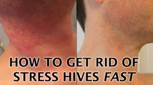 Stress hives come about when you expose the body to excessive stress. Stress Hives Causes Symptoms And Treatments Of A Stress Rash