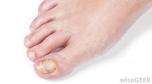 Nail fungus can cause the nail to become thick or ragged and appear yellow, green, brown or black. What Are The Different Causes Of Orange Toenails