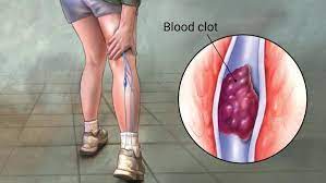 Why Does Covid 19 Cause Blood Clots gambar png