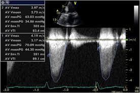 contemporary imaging of aortic stenosis