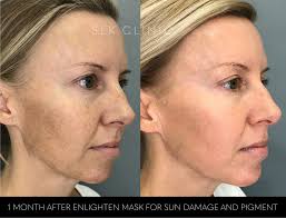 These fifteen remedies are highly effective in curing. Chemical Peels Archives Slk Clinic