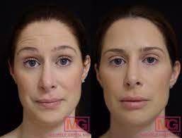 Check spelling or type a new query. Botox Vs Dysport Difference Between Botox Dysport Injections