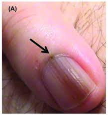 nail unit melanoma clinical features lm