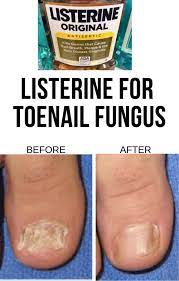 treat toenail fungus