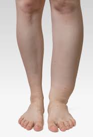 home remes to treat edema in legs