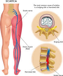 say goodbye to sciatic nerve pain with