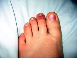 toenail injury information foot