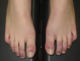 Hand, foot, and mouth disease. Spots On Toes And Rashes Join Weird New Symptoms Of Coronavirus