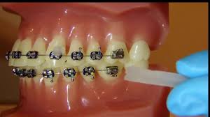 Food gets stuck, wires get. How To Apply Dental Wax On Braces 12 Steps With Pictures