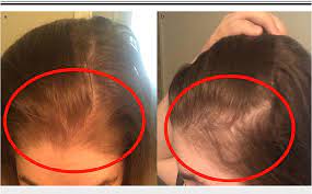 hair loss after surgery why it happens