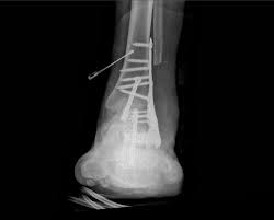 an ankle fusion that hasn t healed