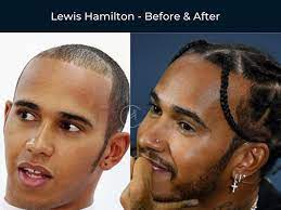 59 celebrity hair transplants before