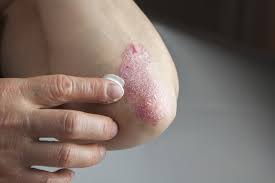 The chronic autoimmune disease psoriasis can cause an array of skin symptoms. How The Skin Disease Psoriasis Costs Us Billions Shots Health News Npr
