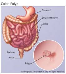 The Basics Of Colorectal Cancer