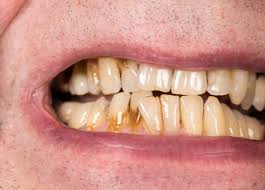 black stains on teeth causes remes