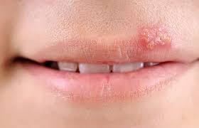 what are cold sores and how can they be