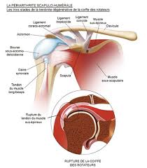 Athletes at risk for a patellar tendon rupture. Symptomes Et Diagnostic De La Rupture Coiffe Des Rotateurs Dr Paillard