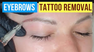 eyebrow tattoo removal