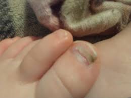 toddler toe nail coming off mumsnet