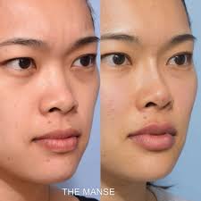 What you can expect to experience after fillers. Nose Filler Best Clinic Sydney For Dermal Fillers