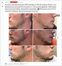 Vitamin b5, b9 and b3 are important for overall health, but b7, found in egg yolk and nuts, holds great importance in growing facial hair. Beard Doesn T Grow On Cheeks Here S How To Fix That Now