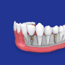 We did not find results for: Cost Of Dental Implants Boston Ma Dentist James M Stein Dmd