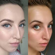 Benefits include low risk in the right hands, no recovery time and instant results. How My Non Surgical Nose Job Changed My Life Bles Magazine Beauty Life Entertainment En Style
