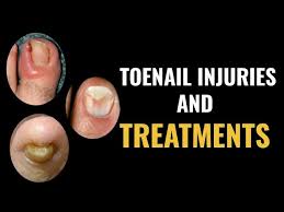 how do i treat a toenail injury you