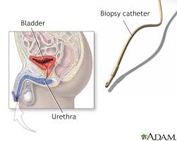 bladder biopsy information mount
