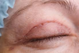 eyelid surgery preparation recovery