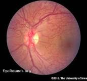Image result for icd 10 code for moderate nonproliferative diabetic retinopathy