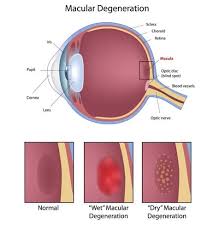 retina disorders macular degeneration