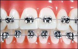Focus On Wires Orthodontic Products