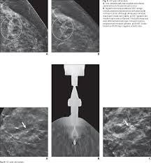 Figure 7 60 From Advances In Digital Breast Tomosynthesis