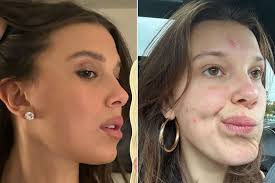 millie bobby brown reveals her acne in