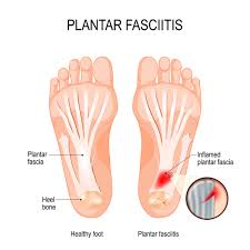 plantar fasciitis signs you have it