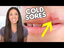 what are cold sores how to get rid of