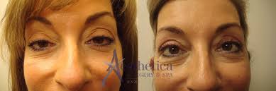 is eyelid surgery covered by insurance