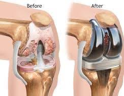 total knee replacement market