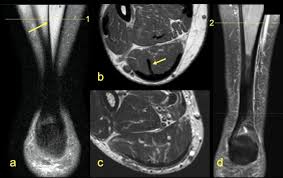 By muhammad ali, mb bs; Distribution Of The Subtendons In The Midportion Of The Achilles Tendon Revealed In Vivo On Mri Scientific Reports