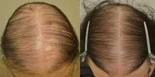 spironolactone hair restoration of
