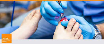 tustin ca laser fungal nail treatment