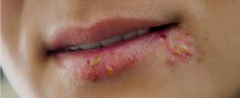 enpox shingles herpes domeboro