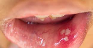 hpv in the mouth symptoms causes and