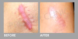 keloid scar treatment removal