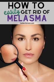 how to get rid of melasma what works