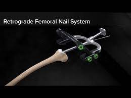 retrograde fem nail system surgical