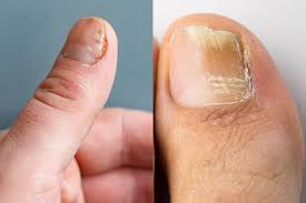 nail fungus and nail psoriasis