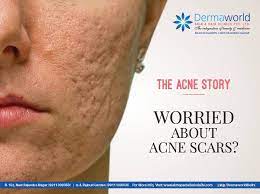 causes how to get rid of acne scars